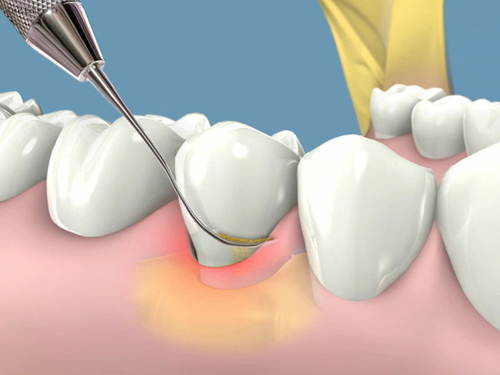 Khi mọc răng khôn có nên nhổ?
