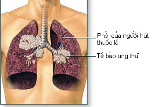 Những tác nhân gây nguy hiểm các bệnh về phổi