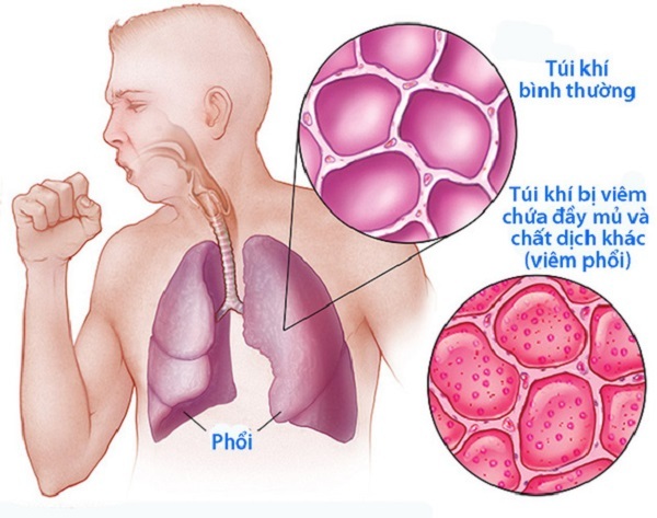 Bệnh viêm phổi cấp