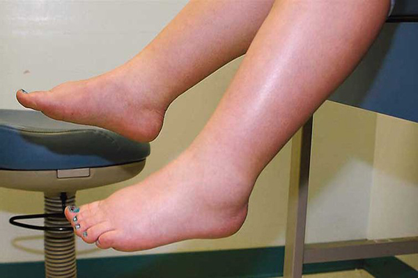 Phát hiện bệnh Thận qua những thay đổi ở bàn chân