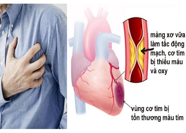 <center><em>Các động mạch ở tim bị thu hẹp bởi các mảng xở vữa bám gây đau thắt ngực</em></center>